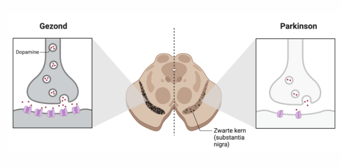<p>Bewegingsproblemen.</p><p>Tekort aan dopamine.</p>