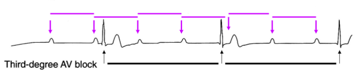 <p><span><br>There is complete electrical block between the atria and the ventricles</span></p><p><span>The AV node fails to conduct any signals</span></p><p><span>P waves occur regularly</span></p><p><span>QRS complexes occur regularly but with low frequency (secondary pacemaker)</span></p>