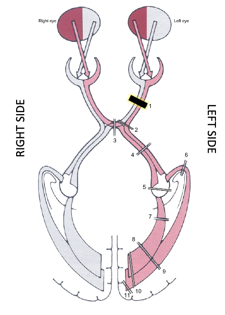 <p>distal optic nerve lesion; progressive lesion of the optic nerve typically causes</p>