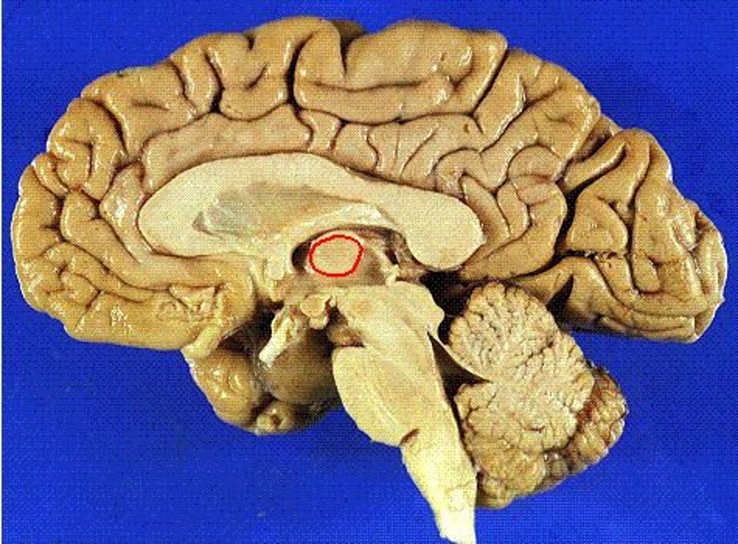 <p>A small, midline mass of gray matter that connects the right and left thalamic bodies</p>