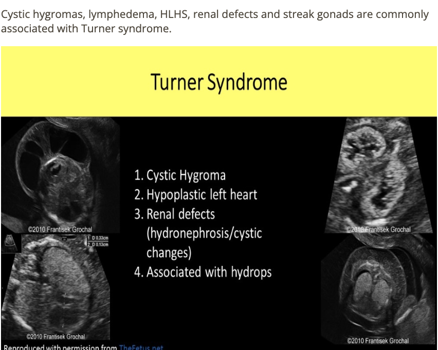 <p>b) duodenal atresia </p>