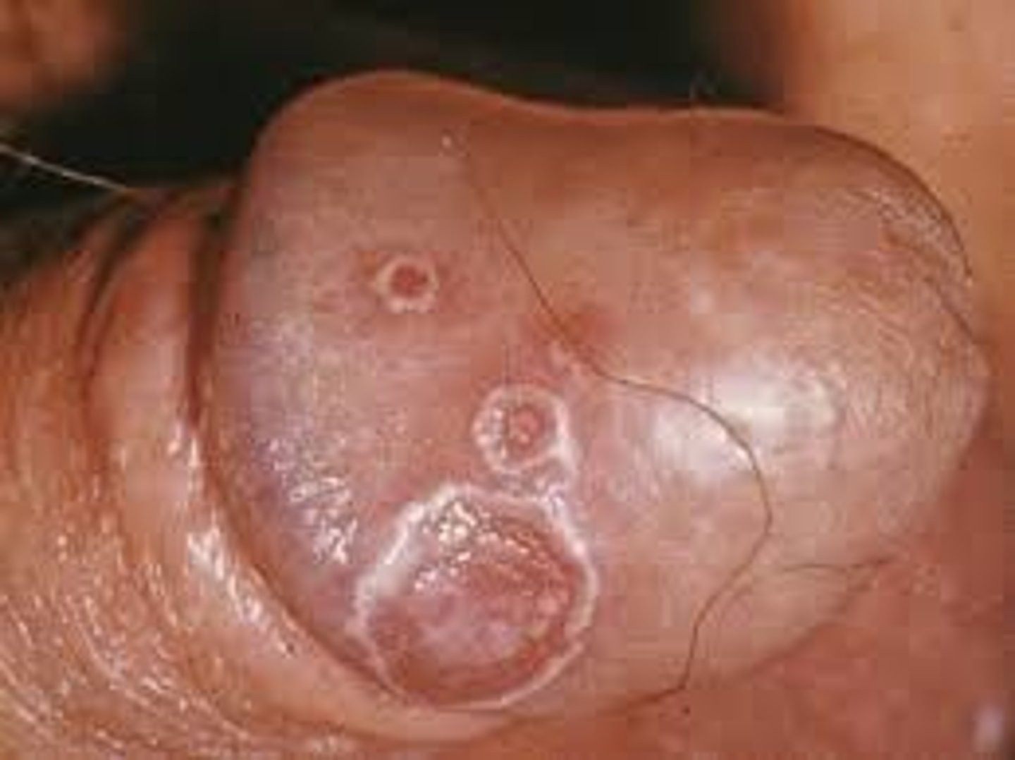 <p>Balanitis circinata (25%)</p>