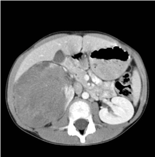 <p>A 4-year-old boy is brought to the pediatrician because of an enlarging abdominal mass noticed by his parents during bathing. The mass is smooth, firm, and does not cross the midline. His blood pressure is elevated at 132/88 mmHg. On exam, he also has aniridia and undescended testes.</p><p>Laboratory studies are normal except for mild anemia. Abdominal CT shows a large, well-circumscribed renal mass confined to the right kidney without nodal disease. Biopsy reveals a triphasic pattern with blastemal, stromal, and epithelial elements. Which of the following best describes the underlying molecular pathogenesis of this patient’s tumor?</p>