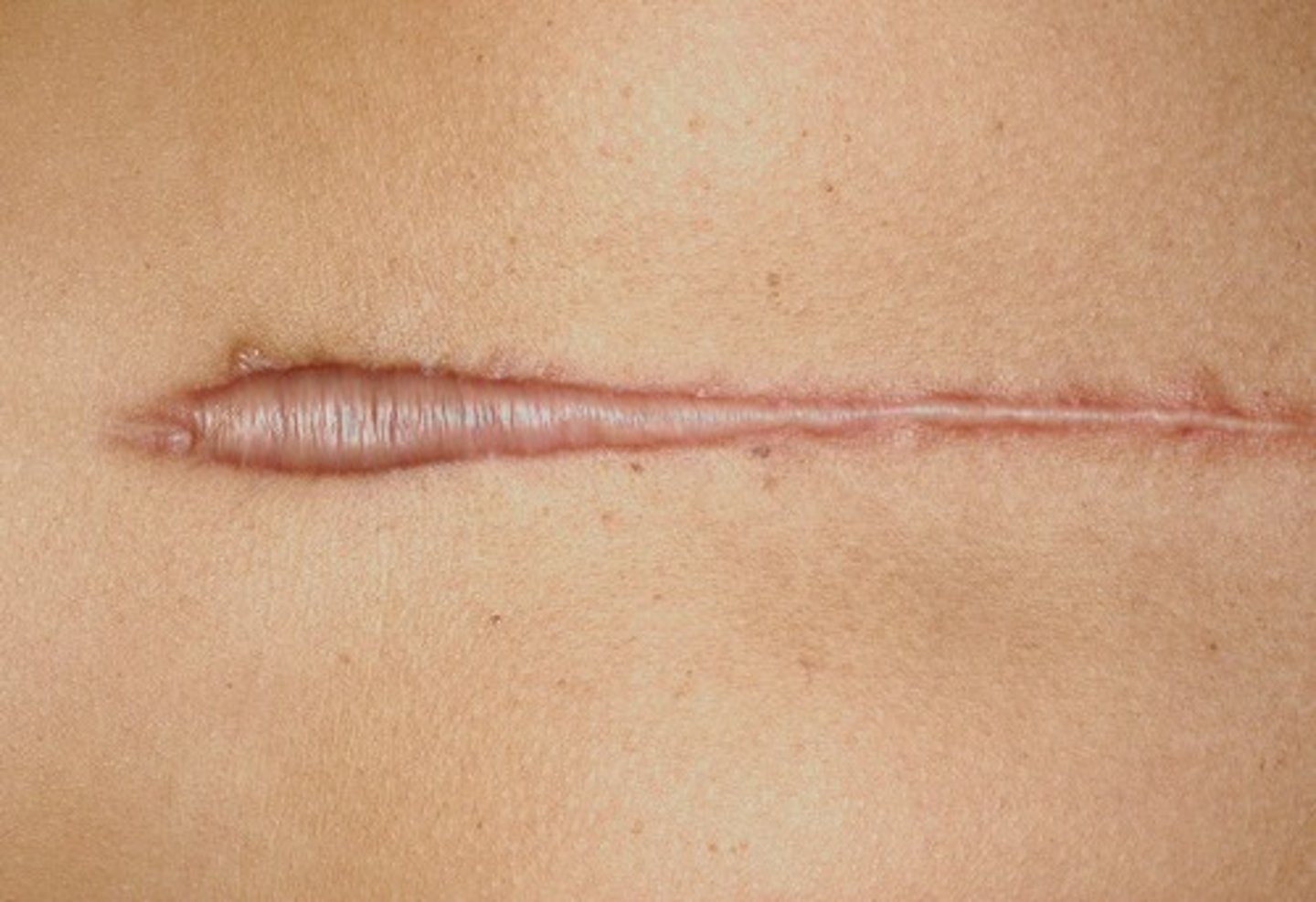 <p>Scars (secondary lesion)</p>