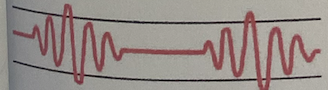 <ul><li><p><strong>Regular</strong> pattern characterized by alternating periods of <strong>deep, rapid breathing</strong>, followed by periods of <strong>apnea</strong></p></li><li><p>May result from</p><ul><li><p>Severe congestive heart failure</p></li><li><p>Drug overdose</p></li><li><p>Increased intracranial pressure</p></li><li><p>Renal Failure</p></li></ul></li><li><p>May be noted in elderly patients during sleep</p></li></ul><p></p>