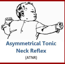 <p><span>Asymmetrical Tonic Neck Reflex also known as Fencing reflex (may be seen with Cerebral Palsy)</span></p>