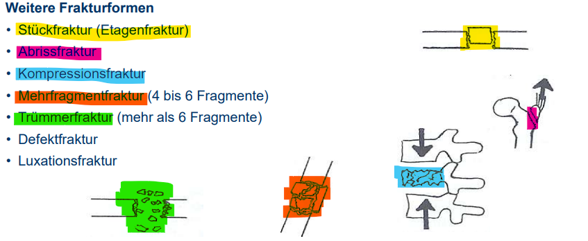 <p>Mehrfragmentfraktur → Trümmerfraktur → Defektfraktur</p><ul><li><p>Luxationsfraktur - Verrenkung kombiniert mit Bruch</p></li></ul><p></p>