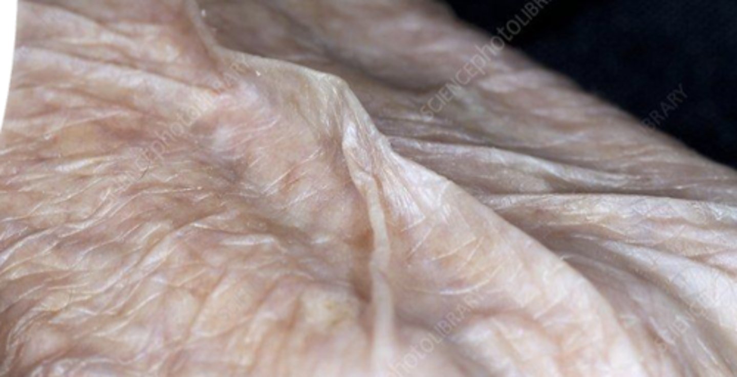 <p>-gets thinner</p><p>-loses elastin, collagen, fat</p><p>-more fragile (risk for skin breakdown, sun damage, burising, injury, etc...)</p><p>-Turgor decreases</p><p>-Decreased melanin production</p>