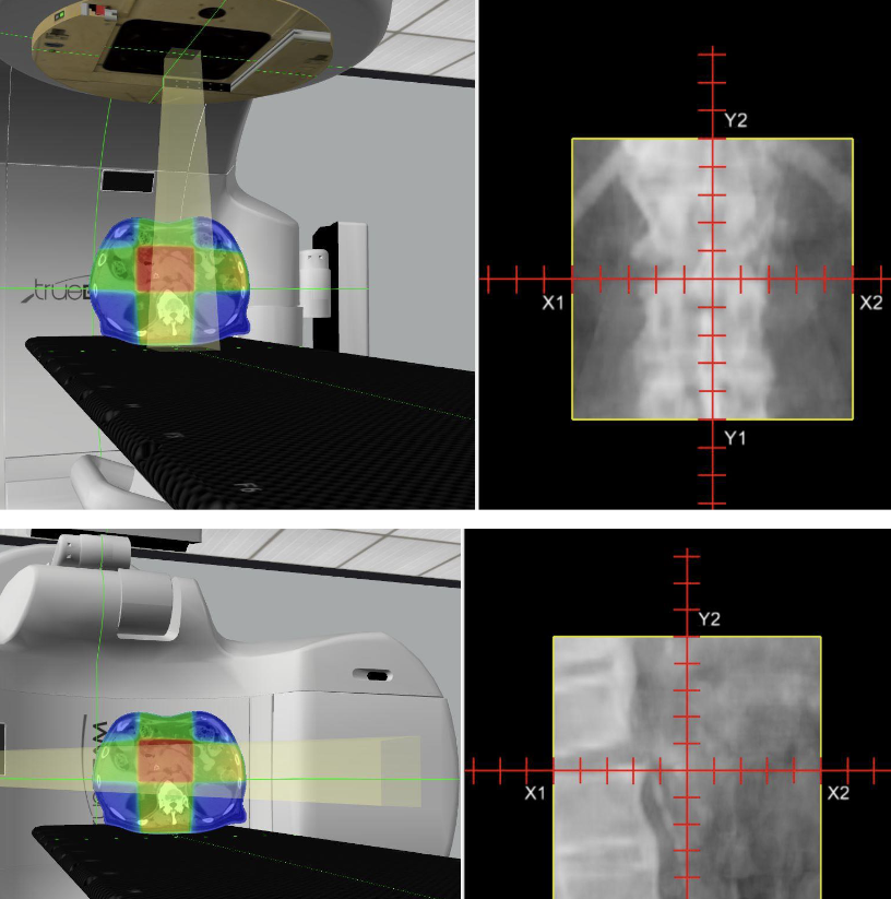 <p>Describe this treatment technique</p>