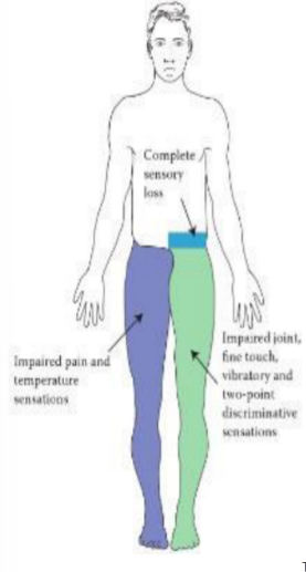<p>Unilateral spinal cord hemisection</p>