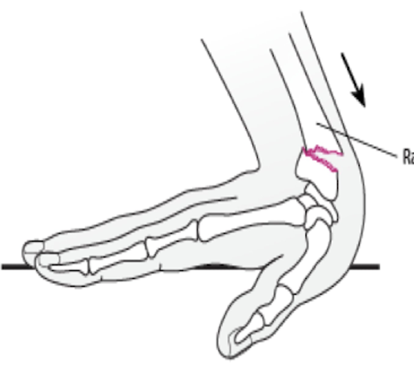 <p>dorsal displacement of radius (distal 2 cm transverse fracture)</p>