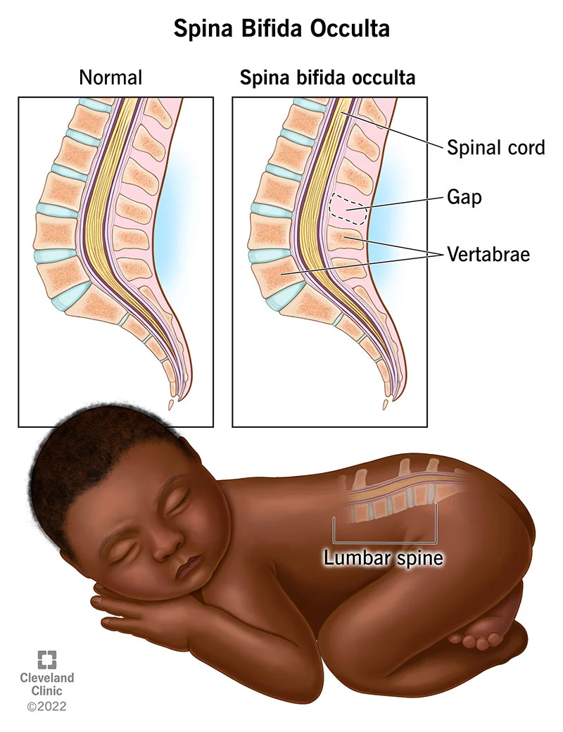 most common and least severe form of spina bifida without protrusion of the spinal cord or meninges
