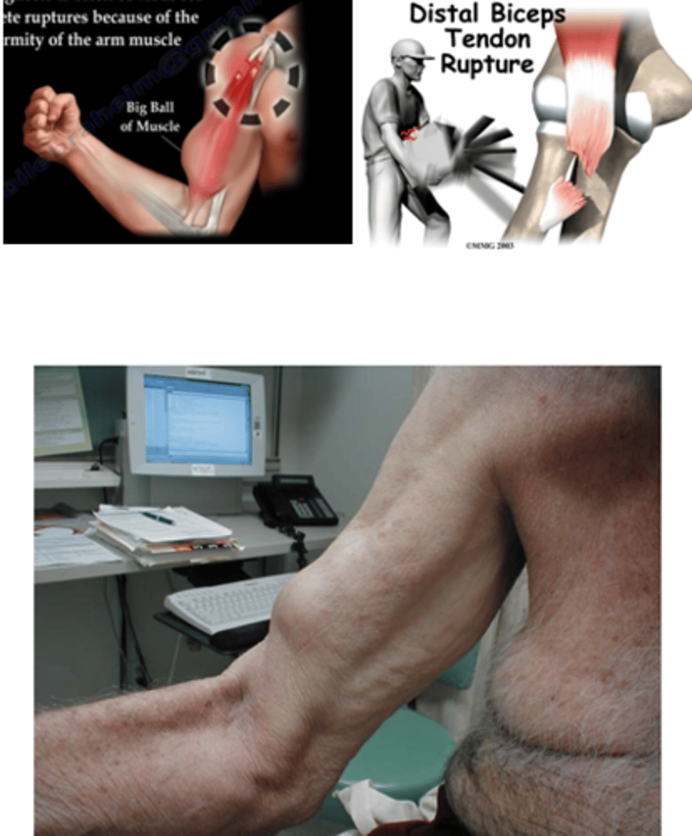<p>- Very quick, and the pain goes away</p><p>- POPEYES!</p><p>- Empty bicipital groove</p>