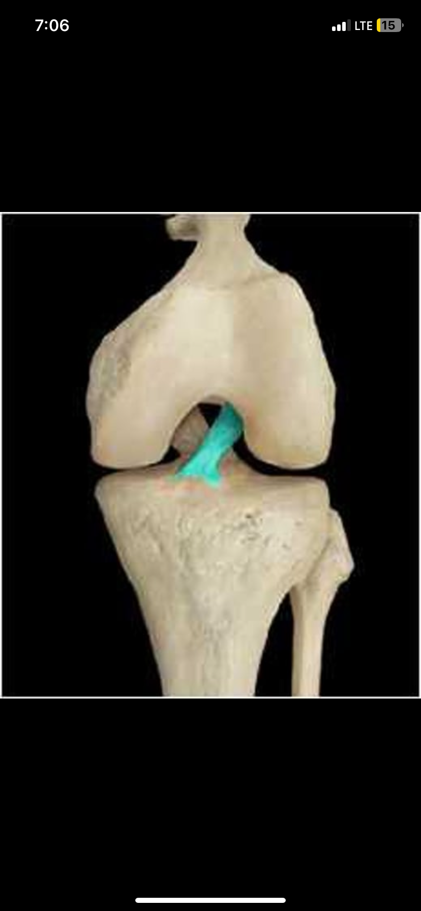 <p>An important ligament located under the patella, within the knee joint, preventing anterior displacement of the tibia.</p>