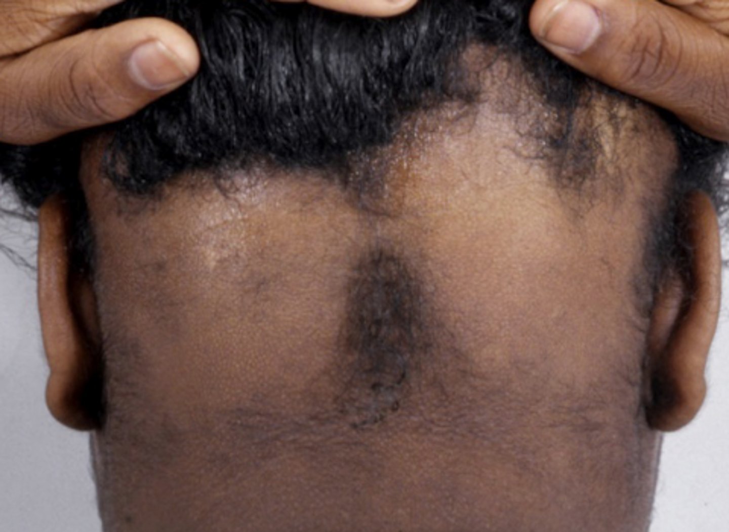 <p>What pattern of hair loss is this?</p><p>3 multiple choice options</p>
