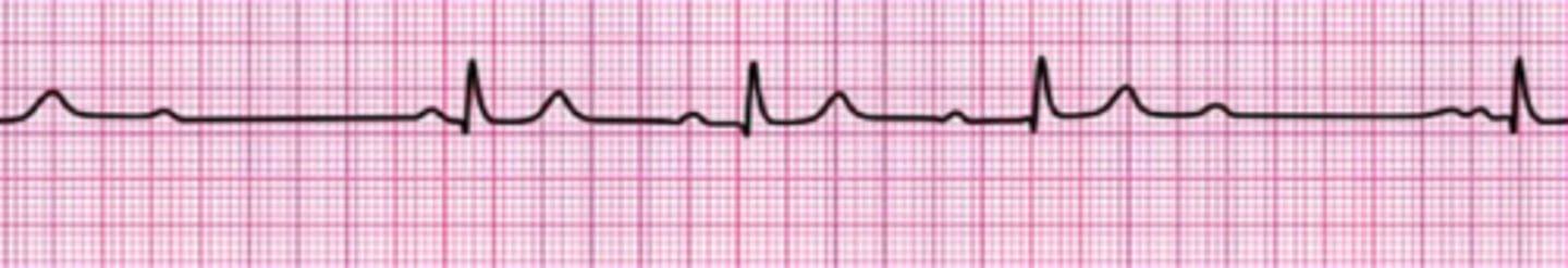 <p>Second-degree atrioventricular block (Mobitz I Wenckebach)</p>