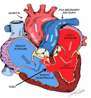<p>Septal defect</p>