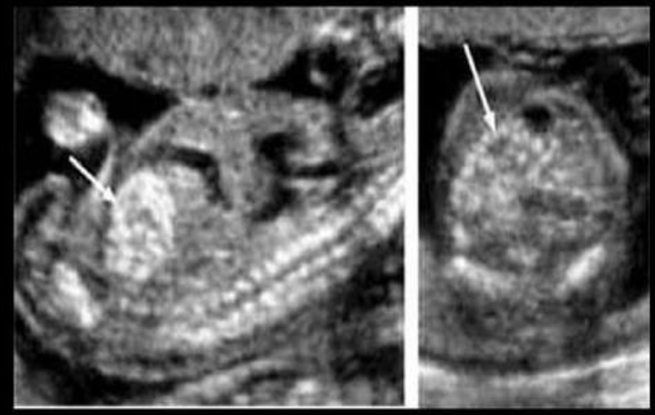 <p>which is most commonly assoc w/abn on the images</p><p>a) holt oram syndrome</p><p>b) noonan sydrome</p><p>c) trisomy 21</p><p>d) trisomy 13</p>