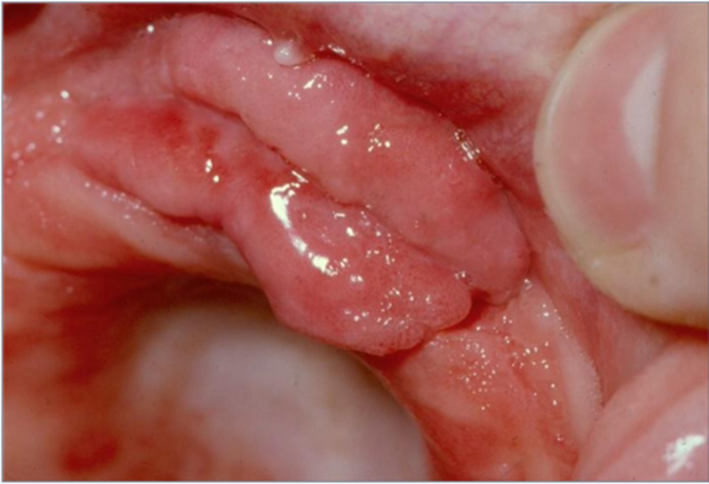 <p>Reactive hyperplasia due to an</p><p>ill-fitting denture or alveolar</p><p>resorption</p>