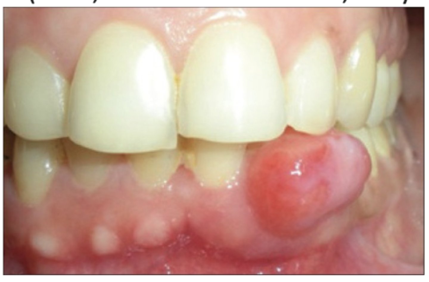 <p>PDL-like cells + calcifications</p><p>• well-defined swelling</p><p>• may be ulcerated</p><p>• common location: anterior gingiva </p><p>• population: females, children/young adults</p>