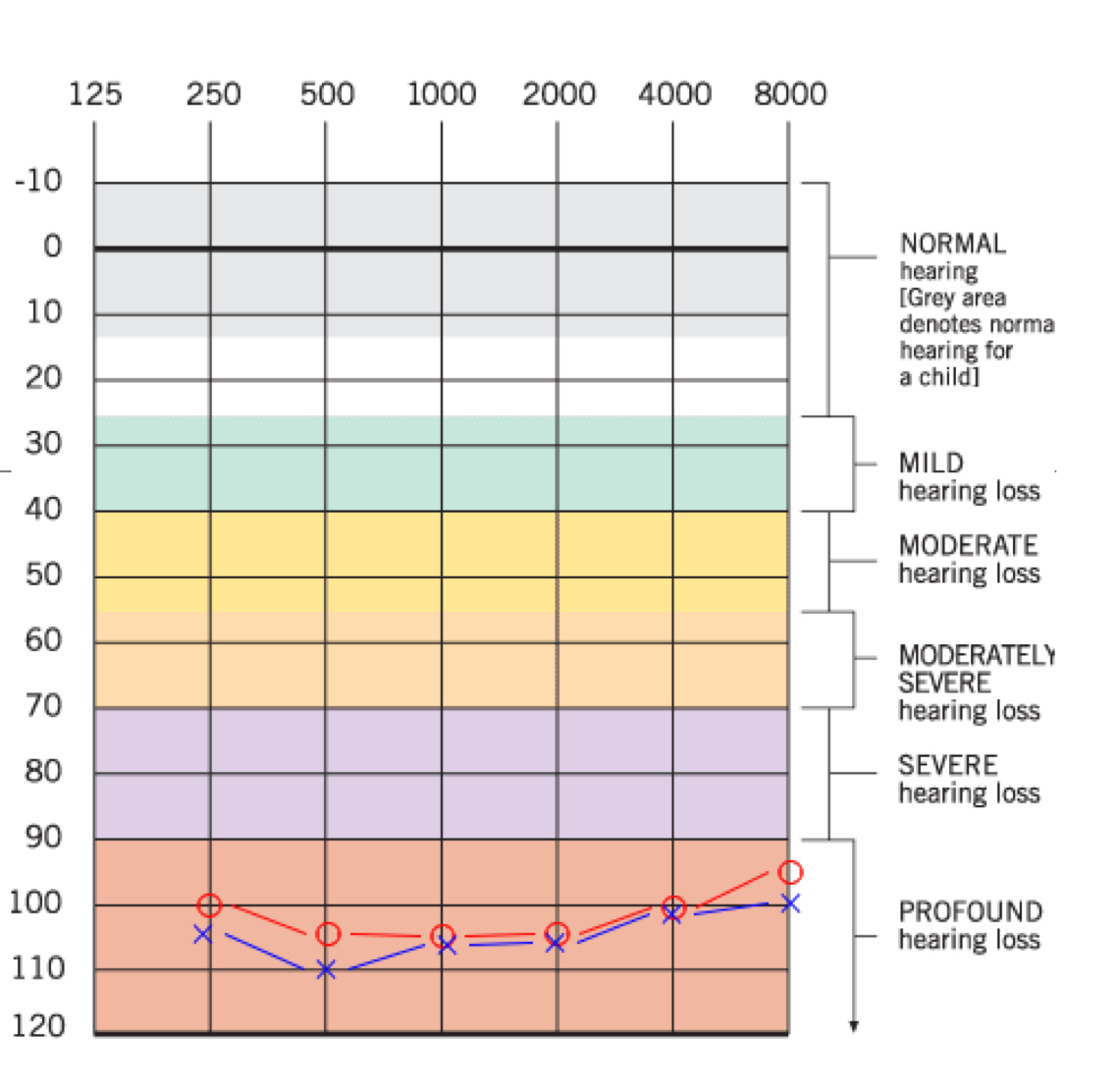 <p>Usually defined as PTA at 500, 1000, 2000 Hz; Hearing losses can be flat, or more of a “corner audiogram” shape. Hearing levels at high frequencies can make a significant impact on the ability to receive speech, since most consonants are high frequency in nature </p>