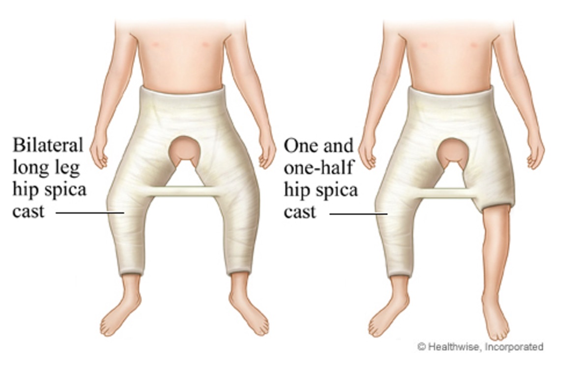 <ul><li><p><span><span>closed reduction surgery w/ spica cast</span></span></p></li><li><p><span><span>spica cast is a lower extremity cast</span></span></p></li></ul><p></p>