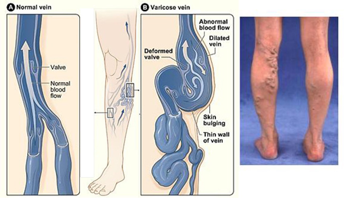 <p><span style="font-family: Calibri">- veins that have become enlarged and twisted due to leaky valves</span></p>