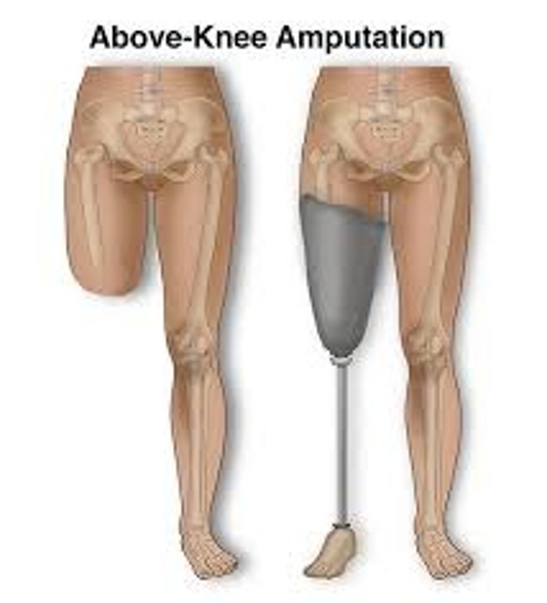 <p>to cut off a part of the body: Cắt cụt chi</p><p>Synonyms: Remove the limb, surgical amputation</p><p>Example: The doctors decided to amputate the limb to prevent the spread of infection</p>