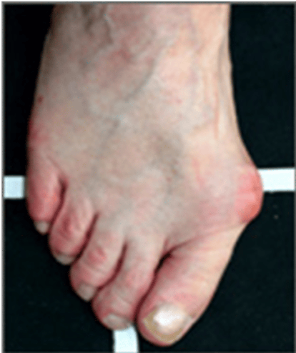 <p>lateral or outward deviation of the great toe</p>