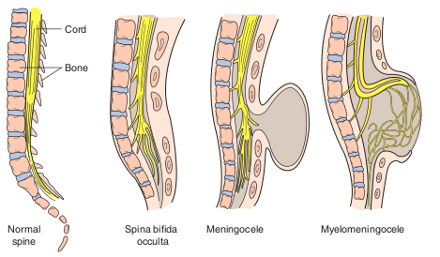 <p>congenital defects in the lumbar spinal column caused by imperfect union of vertebral parts (neural tube defect)</p>