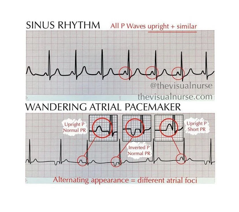 <p>PP: Blocking the breathing-related influence of the vagus nerve on the heart's natural pacemaker and signal pathway</p><p>rate: normal</p><p>rhythm: irregular</p><p>pacer site: shifts back&amp;forth from SA to ectopic (1 or more) atrial pacer sites</p><p>morphology: p’ (abnormal P wave) in any lead</p><p>interval:<br>PR→varies<br>QRS→normal</p><p>E: young<br>old<br>athletes<br>digitalis</p><p>TX: none</p>