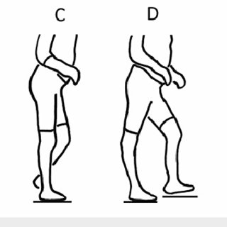 <p><strong>Impairment:</strong> <span style="color: blue">Quadriceps weakness, tight PFS or hamstrings</span><br><strong>Deviation/Compensation:</strong> <span style="color: red">Genu recurvatum</span> — knee hyperextension</p>