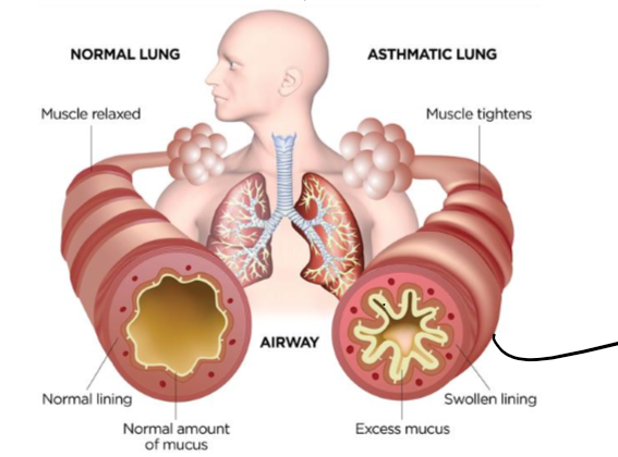 <p>allergen gets picked up on by dendritic cells, these recruit T<sub>H</sub>2 cells which produce cytokinis IL-4 and IL-5, (type 1 sensitivity) causes swollen lining and excess mucus to build up in airway</p>