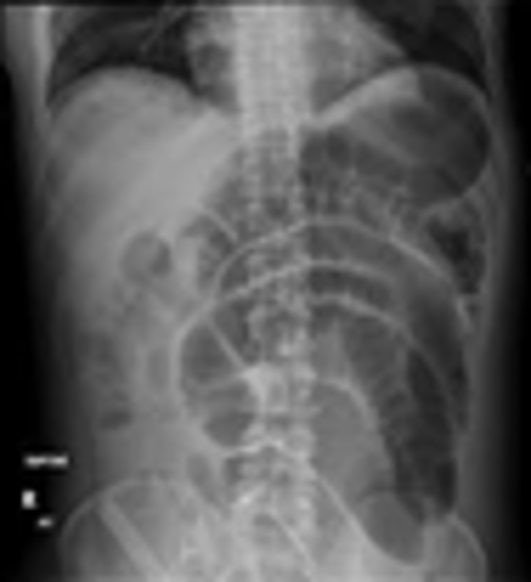 <p>Dilated loops with air-fluid levels, lack of gas in colon</p><p>(FYI - non-diagnostic in 10-20%)</p>