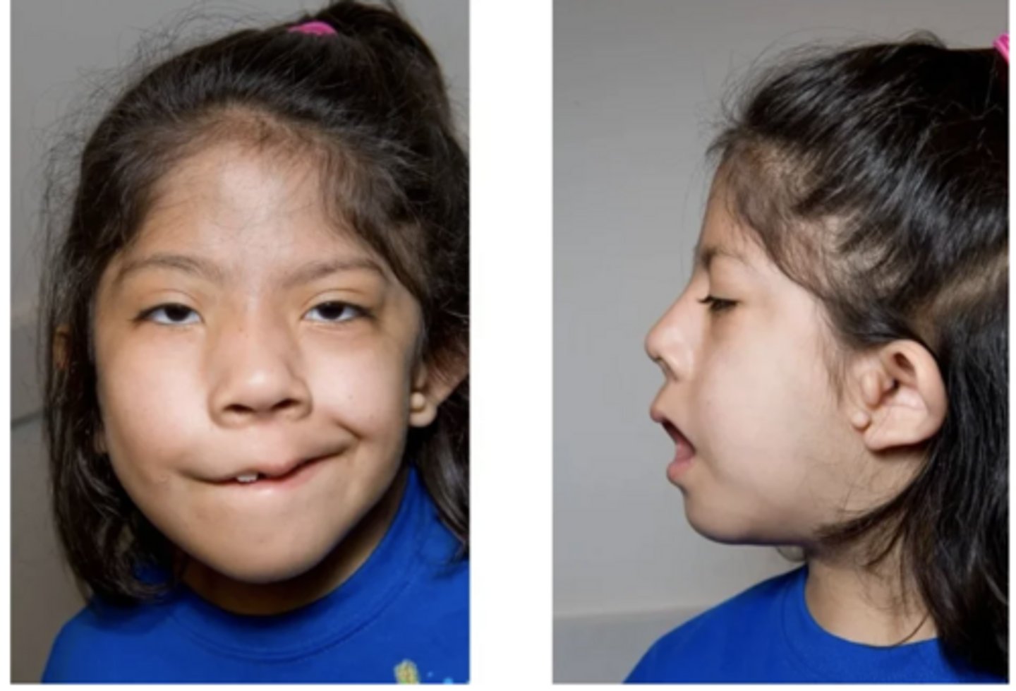 <p>- Oculo-auricular-vertebral dysplasia</p><p>- abnormal development of 1st and 2nd pharyngeal arches</p><p>- characteristic features: microtia, mandibular hypoplasia, microstomia, skin tags and vertebral anomalies</p>