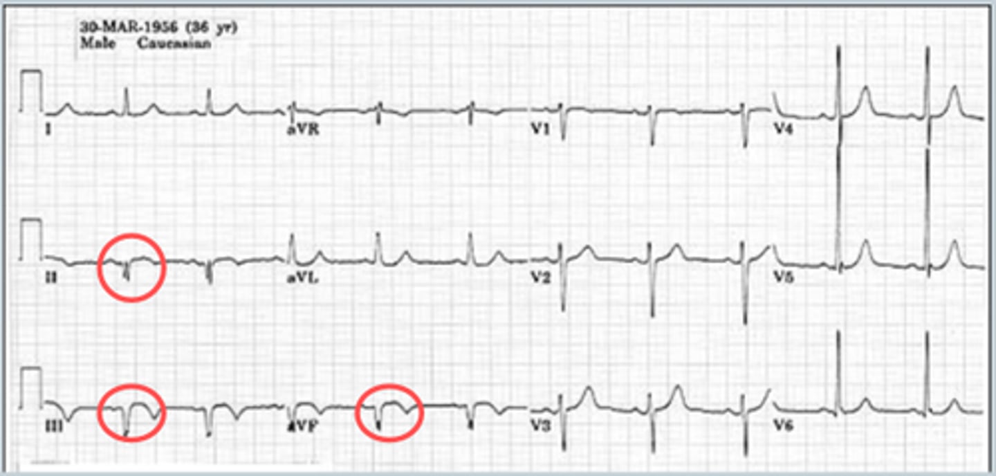 <p>- ST elevation in II, III, and aVF</p><p>- reciprocal ST depression in I and aVL</p>