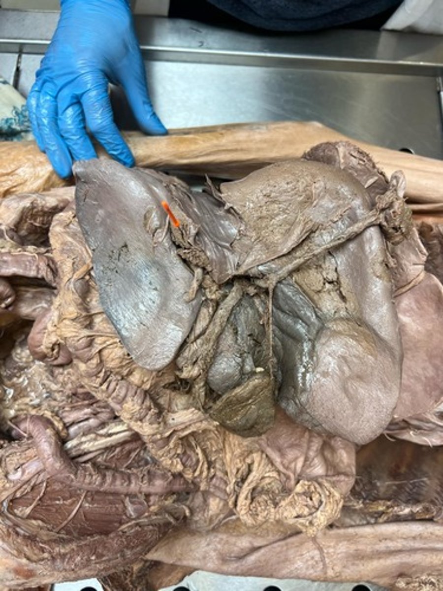 <p>Caudate lobe of liver</p>