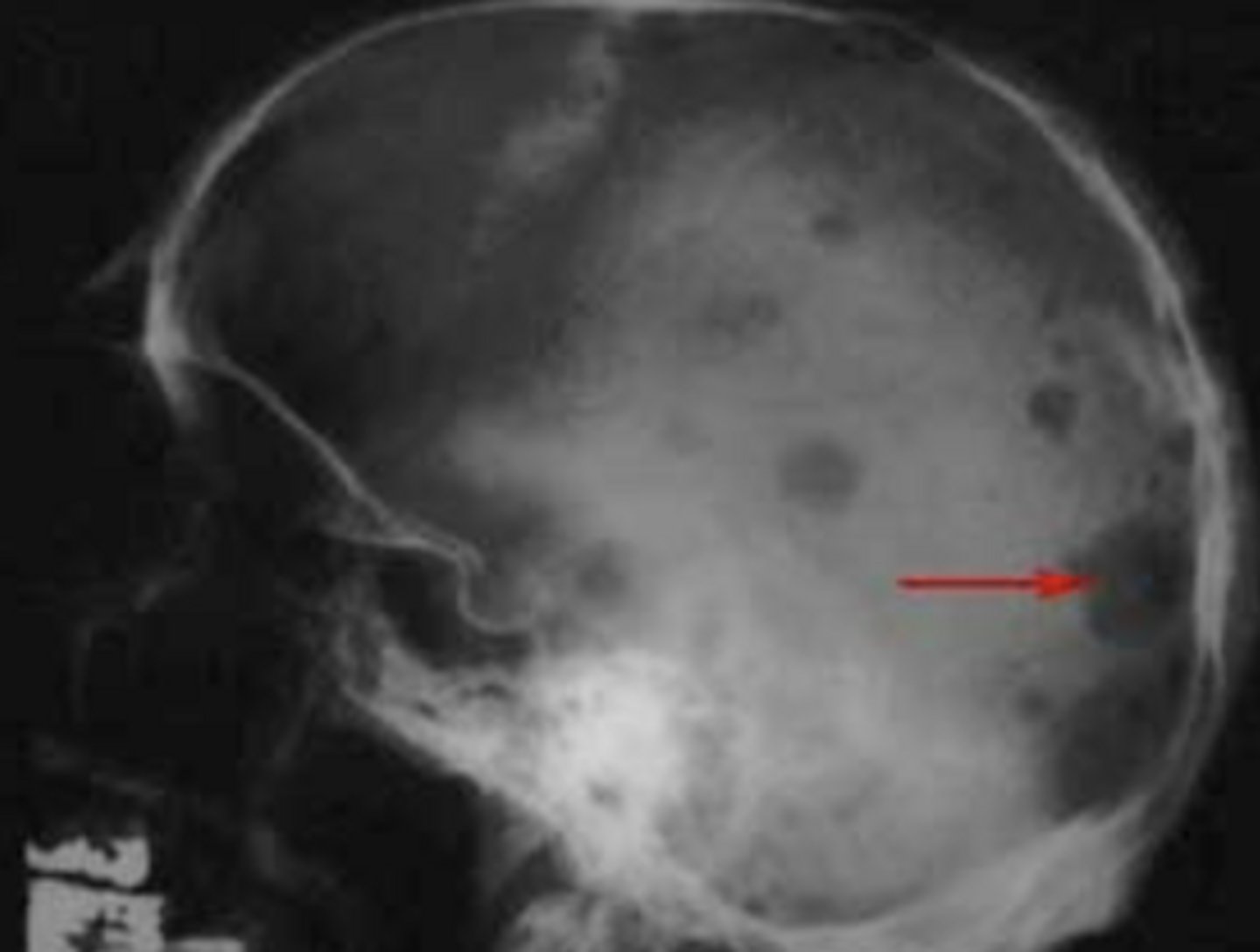 <p>mostly bone tumor but can be anywhere</p>