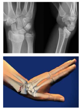 <ul><li><p>distal radius fx </p></li><li><p>brachioradialis - distal radius attachment, pronation/supination&nbsp;</p></li><li><p>may require plates and screws if dislocated&nbsp;</p></li><li><p>acute - cast above the elbow and below the elbow&nbsp;</p></li></ul><p></p>