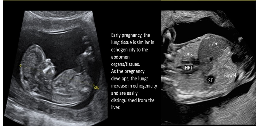 <p>d) increase in echogenicity</p>