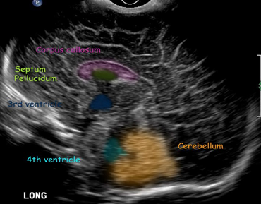 <p>corpus collosum </p><p>4th ventricle </p><p>cavum septum pellucidum (anechoic)</p><p>3rd ventricle </p><p>cerebellum </p>
