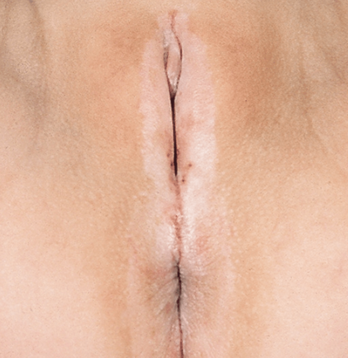 <p>Ter hoogte van de meatus urethra kan ... de oorzaak zijn van de strictuur</p>
