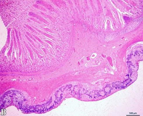 <p>Causes of persistently elevated serum calcium (hypercalcemia)</p>