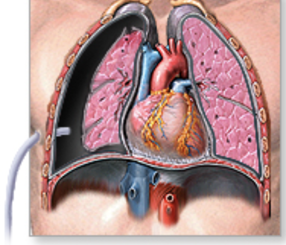 <p>pneumothorax chest tubes</p>