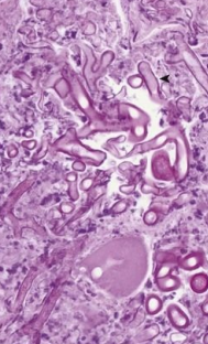<p>8.2 Side B (PBD9: 389; BP9: 313)<br></p>
<p><br></p>
<p>Questions<br></p>
<p>A 37-year-old man has fever and nonproductive cough for 2 weeks. His labs show pancytopenia with myeloblasts and Auer rods. Chest radiograph shows nodular densities; lung biopsy is shown.<br></p>
<p><br></p>
<p>1. What opportunistic infection does he have?<br></p>
<p>2. What is his underlying disease?<br></p>
<p>3. How is this disease spread?<br></p>