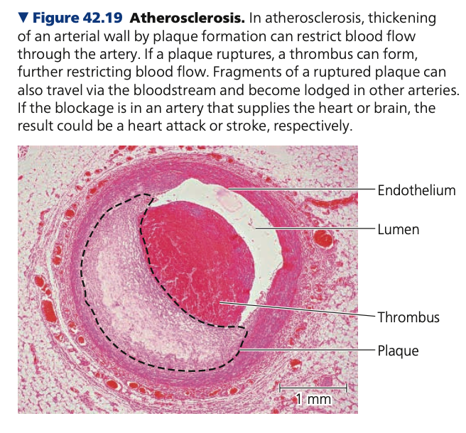 <p><strong>Atherosclerosis</strong></p><ul><li><p>Hardening of the arteries caused by the accumulation of ___ deposits</p><ul><li><p>Damage or infection can roughen the lining and lead to inflammation.</p></li><li><p>Leukocytes are attracted to the damaged lining and begin to take up lipids, including ______.</p></li><li><p>A fatty deposit called a ____ develops in the inner wall of the arteries, causing the wall to become thick and stiff.</p></li></ul></li><li><p>Threat of heart attack or stroke becomes much greater, but there may be warnings of this impending threat</p></li><li><p>Example: _____ pectoris</p><ul><li><p>Occasional chest pains caused by a partially blocked ______ artery</p></li><li><p>Signal that part of the heart is not receiving enough blood, especially when the heart under physical or emotional stress</p></li></ul></li></ul>