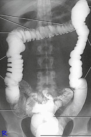 <p>Barium Enema: Identify the Position</p>