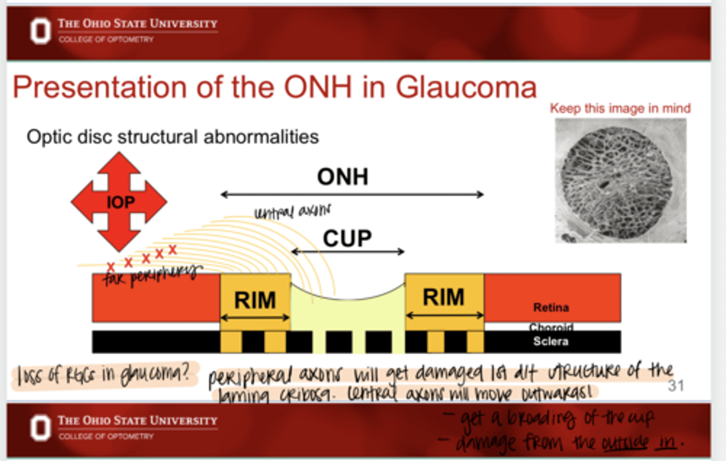 <p>Why do the peripheral RGCs get damaged 1st in glaucoma?</p>