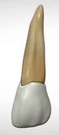 <p>Apical curvature in root (disto-palatal direction). In lateral incisor.</p><p class="has-focus">Files straigten canal and leave apical 3rd uninstrumented</p>