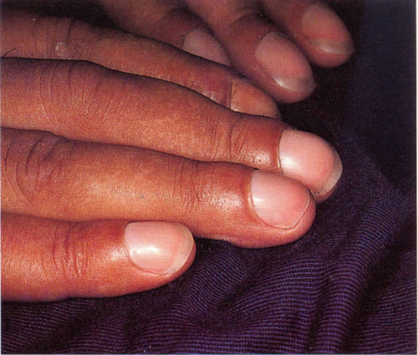 <p>•An uncommon condition associated with autoimmune dysfunction of the thyroid gland (as in Graves' disease) that is marked especially by swelling and clubbing of fingers and toes and periostitis of the hands and feet</p>